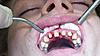 Improper procedure for crowns on front six teeth-2013-01-07_10-13-36_45-jpg