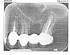 Infected Root Canal Extractions-2-jan-16-2012-jpg