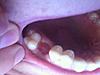 An extraction concern.  For Bryanna or any dental/whole body health literate folks.-photo-9-jpg
