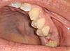 Bone Graft and Implant concerns- Would really appreciate Bryanna's opinion-cropped_number_14-jpg