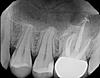 Bone Graft and Implant concerns- Would really appreciate Bryanna's opinion-x3946670-jpg