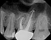Bone Graft and Implant concerns- Would really appreciate Bryanna's opinion-x3946671-jpg