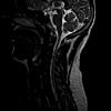 Please read my MRI, Headache ruining my life.-42-jpg