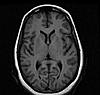 Questions regarding MRI-normal-brain-mri-004-jpg