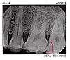 Last molar cracked, to be extracted very worried...-img036-jpg