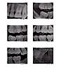 Last molar cracked, to be extracted very worried...-img037-copy-jpg