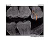 Last molar cracked, to be extracted very worried...-img037-copy-copy-jpg