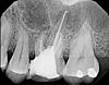 Infection after tooth extraction?-grace_20130613-jpg