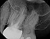 Root Canal vs. Extraction-xray1-jpg