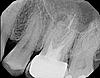 Root Canal vs. Extraction-xray2-jpg