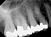 bryanna, is this tooth in my sinus cavity?-9_-jpg-xrays-jpg