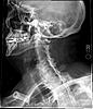 Cervical Spondylotic Myelopathy (CMS)-neck-jpg