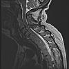 Cervical Spondylotic Myelopathy (CMS)-neck-mri-jpg