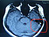 Cerebellar cyst found in MRI-imgp2517-jpg