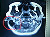 Cerebellar cyst found in MRI-imgp2522-1-jpg