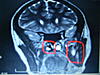 Cerebellar cyst found in MRI-imgp2523-1-jpg