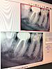 I don't understand infection and dentists' recommendations-photo-4-jpg