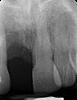 retained root tip-number8-jpg
