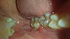 Infection after Wisdom teeth removal question..-20131125_220139-jpg