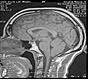 Do I have Arnold Chiari malformation-res1-jpg