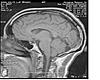 Do I have Arnold Chiari malformation-res2-jpg