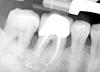 root canaled teeth -- need second opinion-jpg