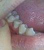 Pain in molar after pre molar inlay-rsz_20140105_165736-1-jpg