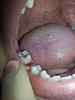 Pain in molar after pre molar inlay-rsz_20140110_102918-jpg