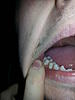 Pain in molar after pre molar inlay-20140114_160959-jpg