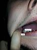 Pain in molar after pre molar inlay-20140114_161005-jpg