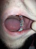 Pain in molar after pre molar inlay-rsz_20140115_191309-jpg
