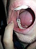 Pain in molar after pre molar inlay-rsz_20140115_191259-jpg