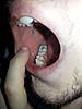 Pain in molar after pre molar inlay-rsz_20140115_191303-jpg