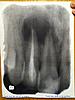 Two Root Canals...The Problem Continues.-photo1-jpg