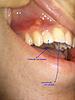 Two Root Canals...The Problem Continues.-toot-gum-jpg