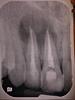 Two Root Canals...The Problem Continues.-img_20140121_184347_207-jpg