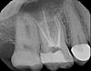 Two root canals &amp; the pain remains the same...-x07975-jpg