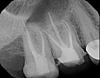 Two root canals &amp; the pain remains the same...-x07975_1-jpg