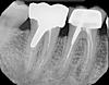 root canaled teeth -- need second opinion-x002208-jpg