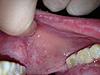 Oral Cancer. Question-image-jpg