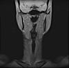 MRI of neck and throat-i0000000-jpg