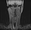 MRI of neck and throat-i0000002-jpg
