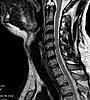 I need help with my neck! Help with MRI if Possible-neck-jpg