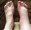 Questions about treatments...-swollenfeet-jpg