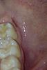 Gum/Cheek problem months after wisdom tooth removal-left-jpg