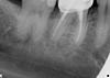 Continued pain after root canals-retx-30-pre-jpg