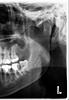 Lower wisdom tooth extraction fear-tooth-jpg