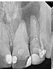 Cyst or infection? serious?-the_tooth-jpg