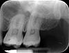 Opinions on problematic tooth? - Bryanna-tooth-jpg