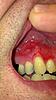 Infection after molar extraction-imag1944-1-jpg